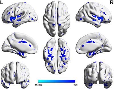 Improved Interhemispheric Functional Connectivity in Postpartum Depression Disorder: Associations With Individual Target-Transcranial Magnetic Stimulation Treatment Effects